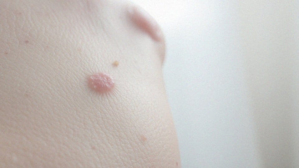 Jakie są objawy związane ze świądem skóry?